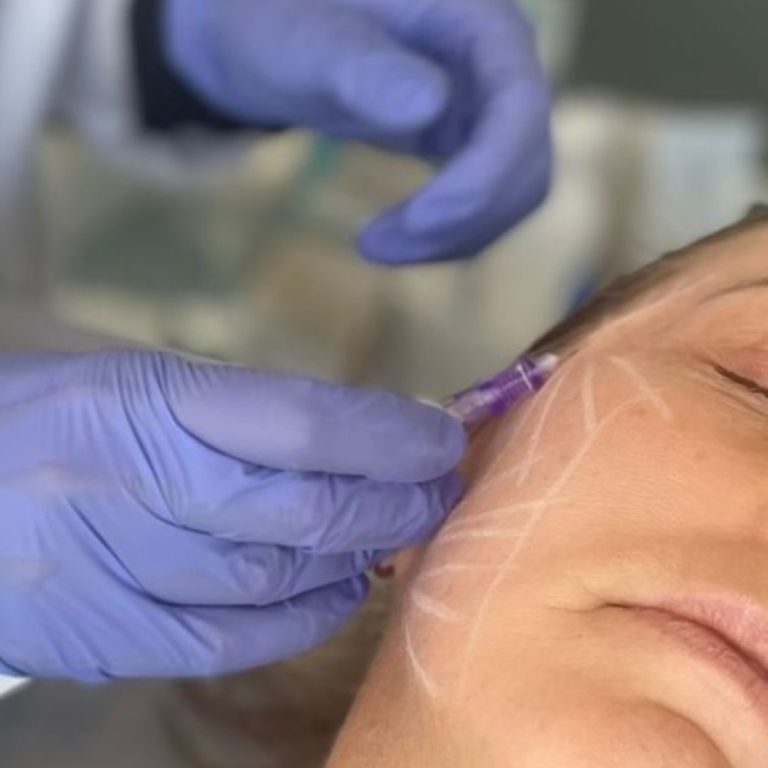 Bioestimuladores de colágeno