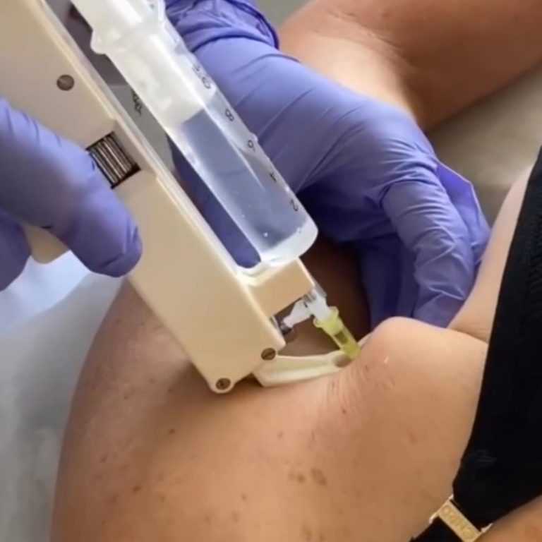 Mesoterapia