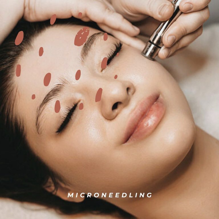 Microneedling