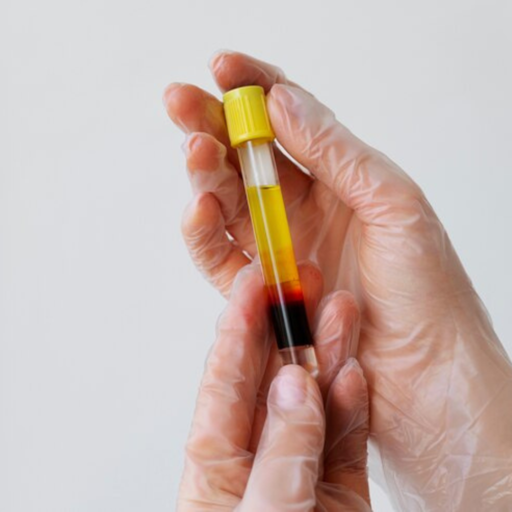PRP Plasma Rico em Plaquetas