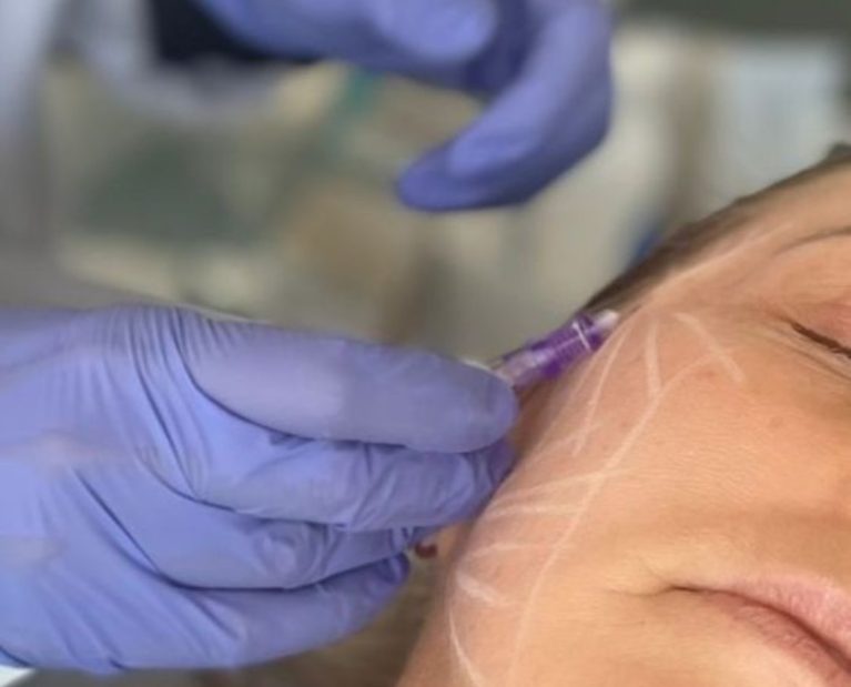 Botox- A Toxina Botulínica é um dos tratamentos médicos mais eficazes e populares para suavizar os sinais de envelhecimento e tratar diversas condições funcionais.