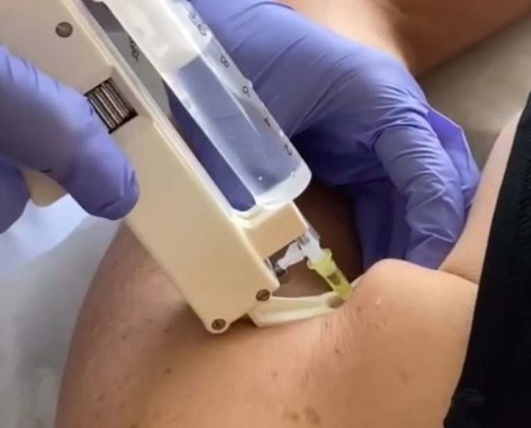 mesoterapia corporal para celulite e gordura localizada no Porto