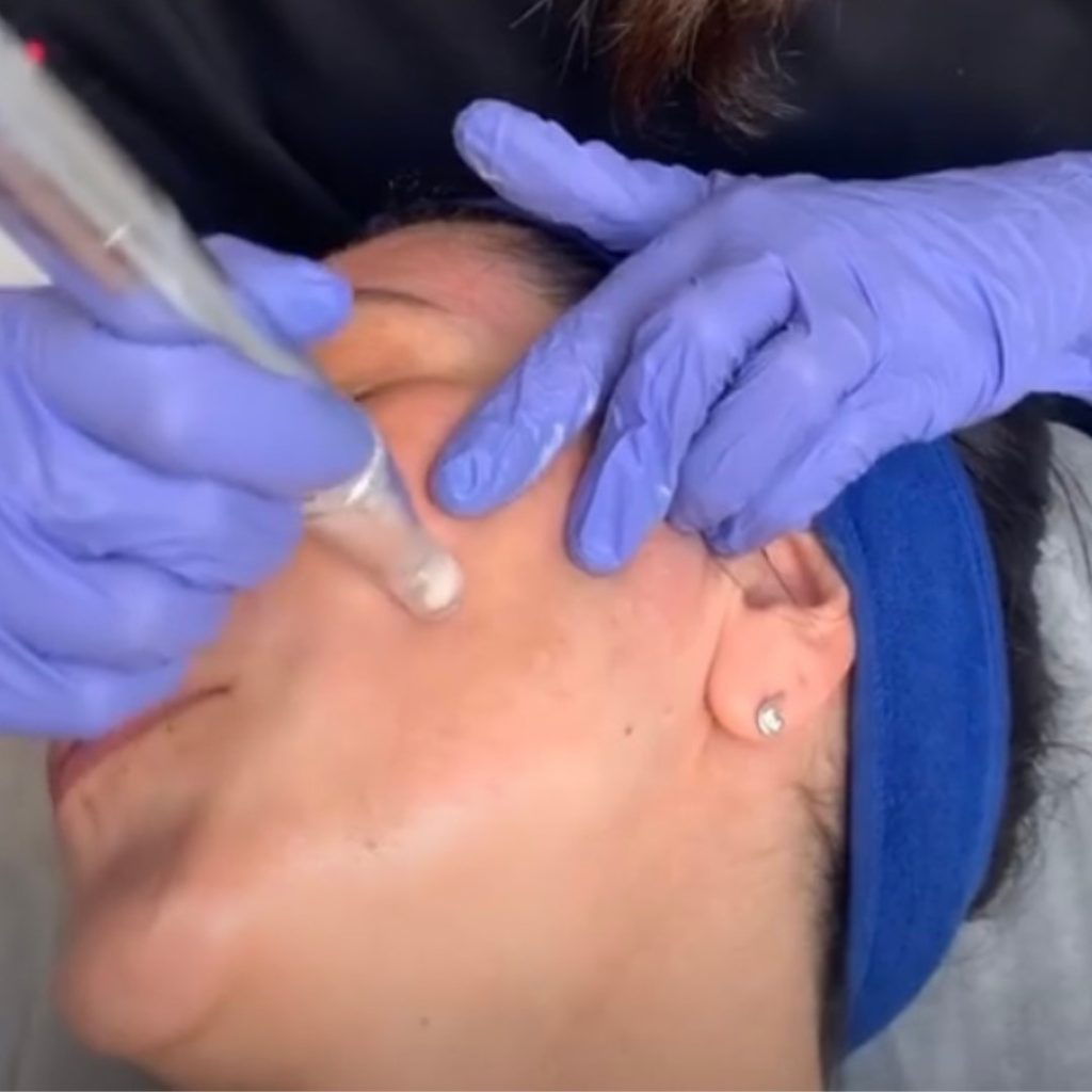 Peeling com microneedling no Porto