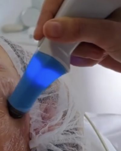 Exilis Facial O exilis 360 tem a capacidade, o controlo de temperatura e frequência ideais para a zona do rosto e pescoço, bem como para a pele fina das mãos.