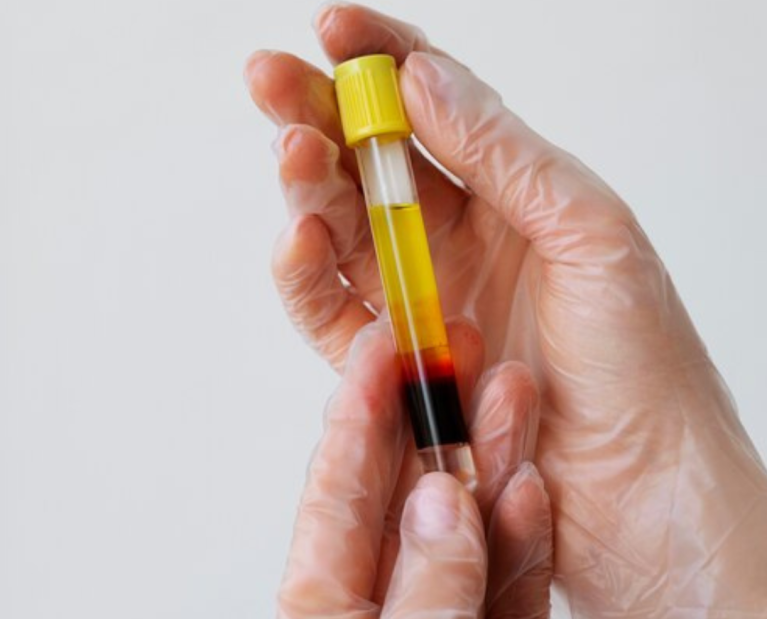 PRP- Plasma Rico em Plaquetas