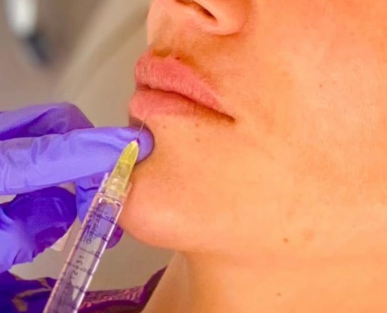 Ácido Hialurónico Preenche e hidrata a pele, melhorando contornos faciais.